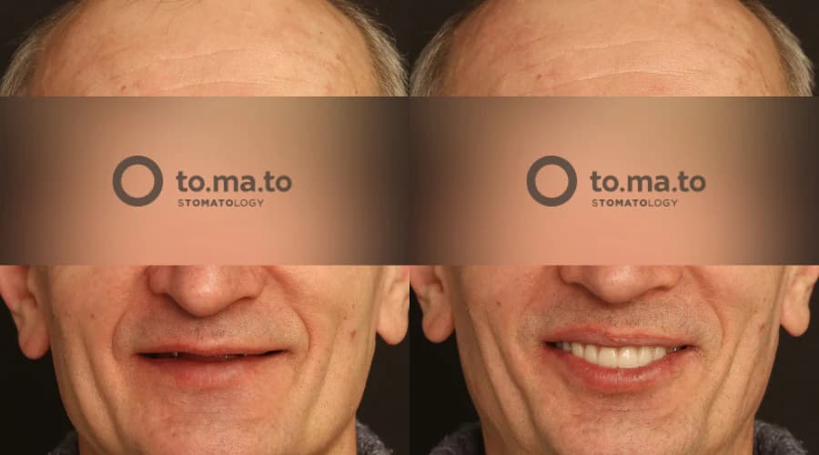 Результат лечения — Восстановление зубов на верхней челюсти по концепции All-on-4